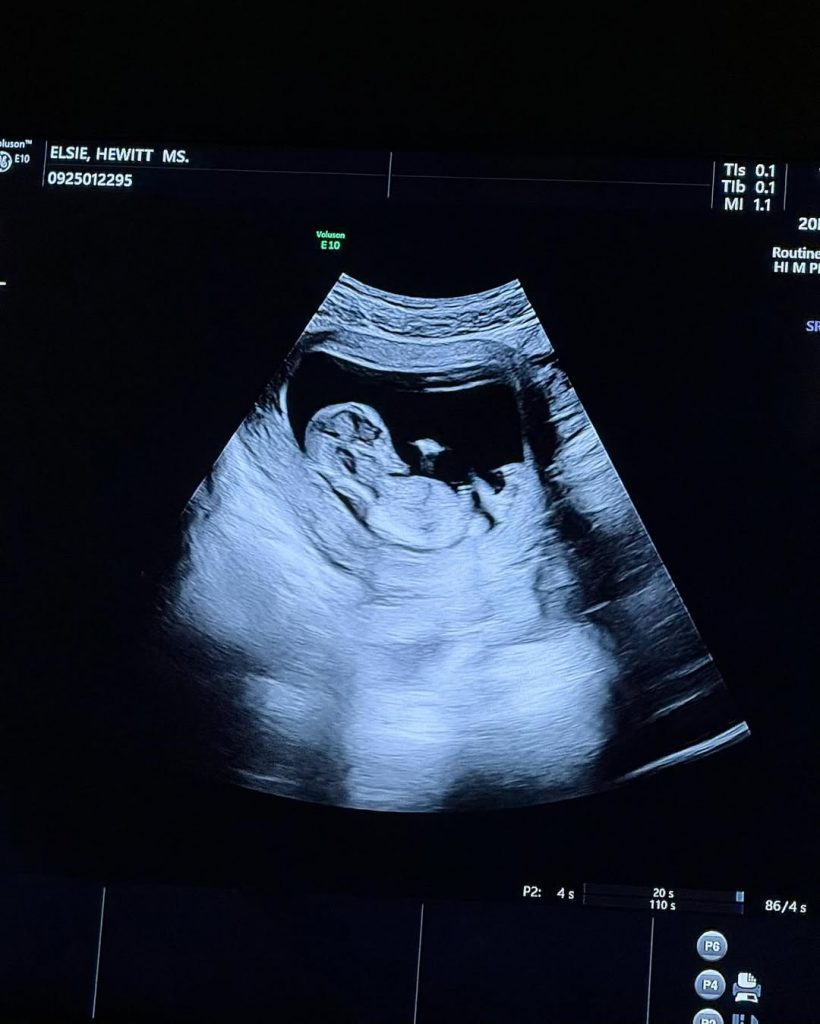 Actor Pete Davidson to become a father for the first time